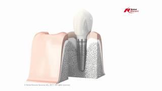 Dental Implants | Nuffield Dental Clinic Singapore