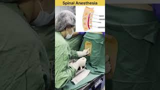 Spinal Anesthesia Procedure #doctor #mbbs #anesthesia #neet #medical #medicalstudent #medico #short