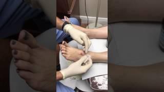 Aspiration and Drainage Cyst from Foot