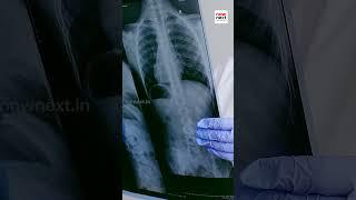 എക്സ്റേ  എന്ന അബദ്ധം | X-Ray History #xray #nownext