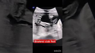 Bilateral club foot