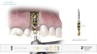 Step by Step Video Astra Tech Implant System EV