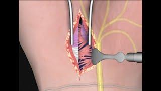 Carpal Tunnel Surgery by Cal Shipley, M.D.