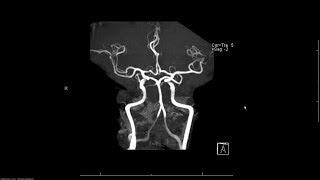 MRA (magnetic resonance angiogram) head radiology search pattern