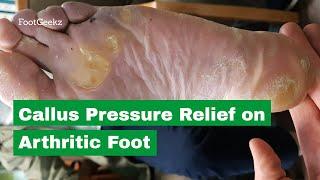 CALLOUS PRESSURE RELIEF ON RHEUMATOID ARTHRITIC FOOT