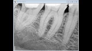 Lower molar with distal fracture