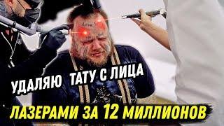 УДАЛЯЮ ТАТУ С ЛИЦА САМЫМ МОЩНЫМ ЛАЗЕРОМ В МИРЕ !