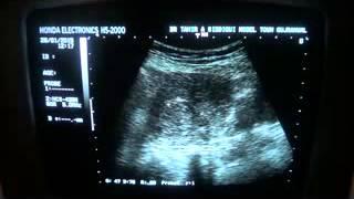 UTERINE MYOMA with mass effect on the endometrial canal