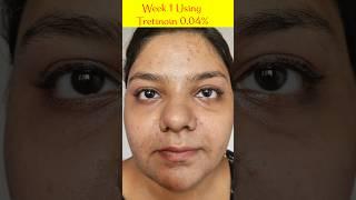 Tretinoin 0.04% Use Only ON Doctor Recommendation, #pharmacy #tretinoincream #retinol #acne #treat