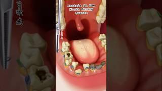 Braces in the Mouth with Full of Bacteria