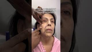 Patient Got Her Glow Back After Full Facial Rejuvenation 