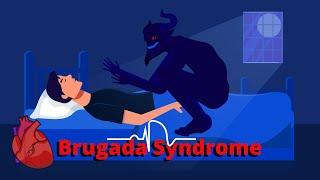 What is Brugada Syndrome? ECG, Symptoms, Pathophysiology, & Treatments