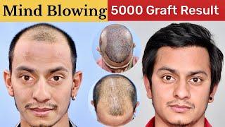 This is Unbelievable Hair Transplant Result | 30 Months Hair Transplant Result