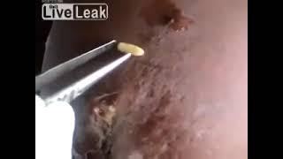 Паразиты. Личинки овода извлекли из груди женщины. Botfly Larvae Removed from Woman's Breast