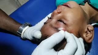 Skin tag removed  || minor surgery || #whatilearntoday