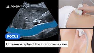 Point of Care Ultrasound of the Inferior Vena Cava (IVC) - AMBOSS Video