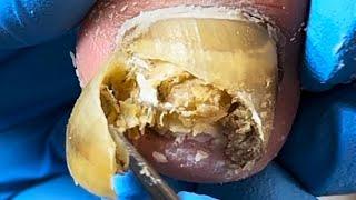 Poor Thick Onychomycosis, Shaped Like Stairs【Podiatry Clinic】