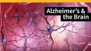 How Alzheimer's Changes the Brain