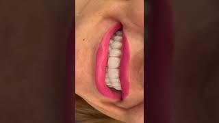 dental crown with beautiful smail