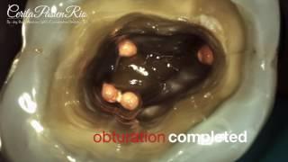 My endo resto revision treatment story on maxillary molar with 4 canals (spesialis konservasi gigi)