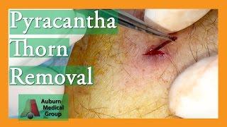 Foreign Body Removal of Pyracantha Thorn | Auburn Medical Group