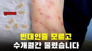 빈대인줄 모르고 수개월간 흡혈 당함! 빈대 한마리만 붙여와도 이렇게 됩니다