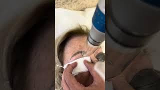 Eyebrow Tattoo Removal Session