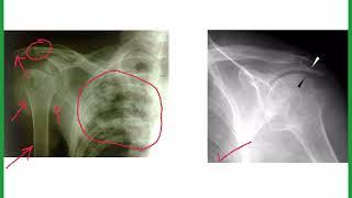 "SHOULDER JOINT"DISEASES APPROACH ON X-RAY BY AN EASY WAY