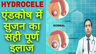 Hydrocele  ( testies swelling  ) || हाइड्रोसिल का सही इलाज! || Dr Kumar Education Clinic