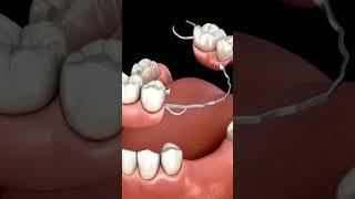 Animated Removable Partial Denture