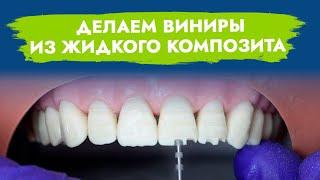 Композитные виниры. Прямая методика изготовления при помощи жидкого композита.