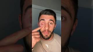 HOW I LOST MY EYE