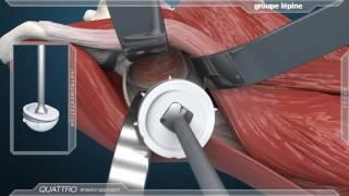 Anterior Approach & Dual Mobility Acetabular Component 3D Animation