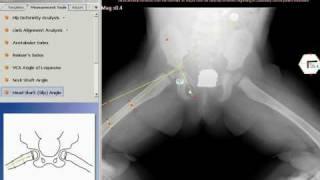 TraumaCad - Head Shaft (Slip) Angle