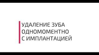 Удаление зуба одномоментно имплантацией