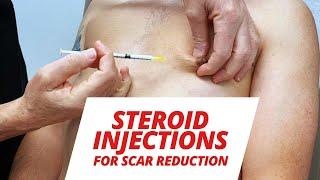 Steroid Injections After Gynecomastia Surgery (SCAR TISSUE REDUCTION)