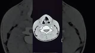 Small internal laryngocele CT -3D