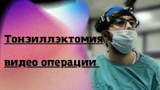 Тонзиллэктомия (видео операции)