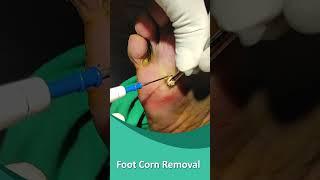 Foot Corn Removal #shorts