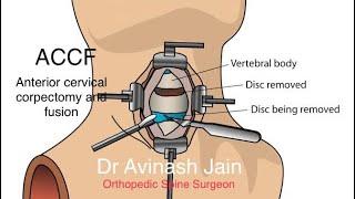 Cervical Spine surgery -ACCF (Anterior cervical corpectomy and fusion )