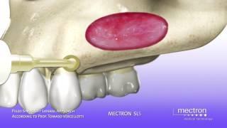 PIEZOSURGERY - ANIMATION - Sinus lift with lateral approach - Sinus Lift Technique (Vercellotti)