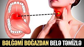 Bəlğəmdən Əziyyət Çəkirsiz? - Boğazınız Tam Təmizlənəcək!