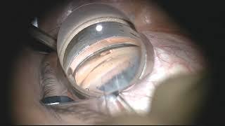 Bac Nguyen, MD: Kahook Dual Blade® (KDB) Utilizing Trypan Blue