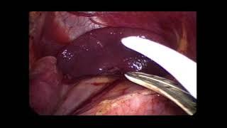 lap fundoplication by prof Wael Tobar MD