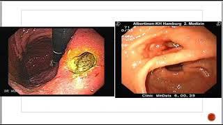 Лекция: Осложнения язвенной болезни желудка: перфорация и стеноз