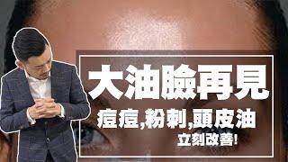 大油臉再見！一周控油改善痘痘、粉刺、頭皮油！【77老大】