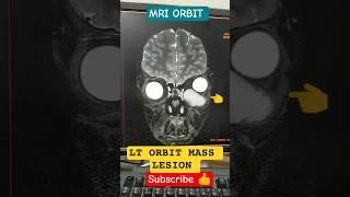 MRI ORBIT आँखों की एमआरआई स्कैन #radiology #mri #orbit #mass #lesion #science #medicalimaging