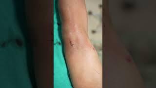 Lipoma cure | Multiple Lipoma removal #shorts