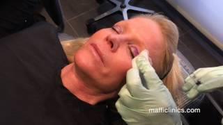 Maffi Clinics: Upper Eyelid Surgery (Blepharoplasty)