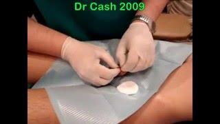 Мужской интим пирсинг "принц Альберт"  Male intimate piercing by master Dr Cash +18